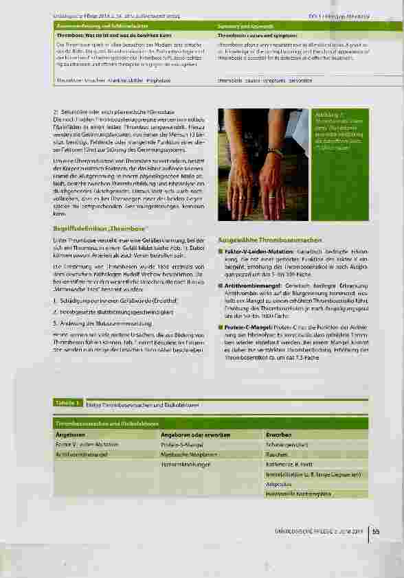 Vorschauseite 2: Thrombose: Was sie ist und was sie bewirken kann