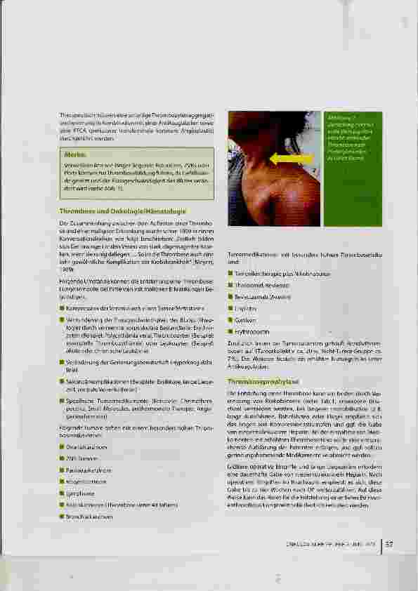 Vorschauseite 4: Thrombose: Was sie ist und was sie bewirken kann