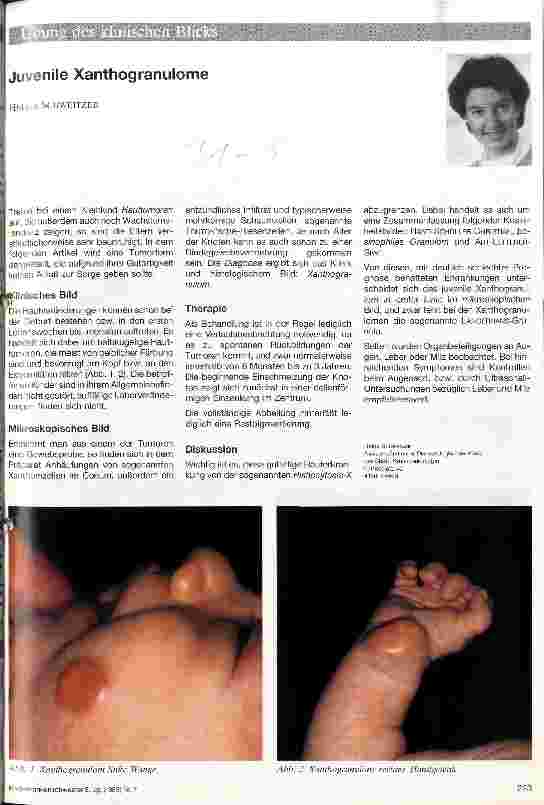 Vorschauseite 1: Juvenile Xanthogranulome