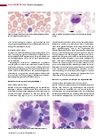 Vorschauseite 3: Thrombozytopoese (Teil 5) Hereditäre Thrombozytopenien