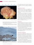 Vorschauseite 3: Merkelzell-Polyomavirus Auslöser des bösartigen Merkelzell-Karzinoms