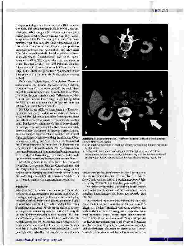 Vorschauseite 4: Thermoablation von Nierentumoren: Indikationen, Techniken und Ergebnisse