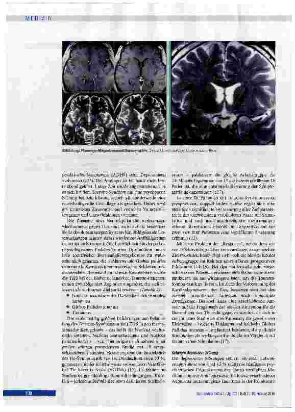 Vorschauseite 4: Tiefe Hirnstimulation bei psychiatrischen Erkrankungen
