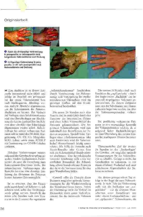 Vorschauseite 4: Verbrennungsbehandlung