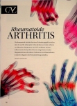 Vorschauseite 1: Rheumatoide Arthritis