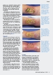 Vorschauseite 3: Atraumatische Wundversorgung beim Pyoderma gangraenosum
