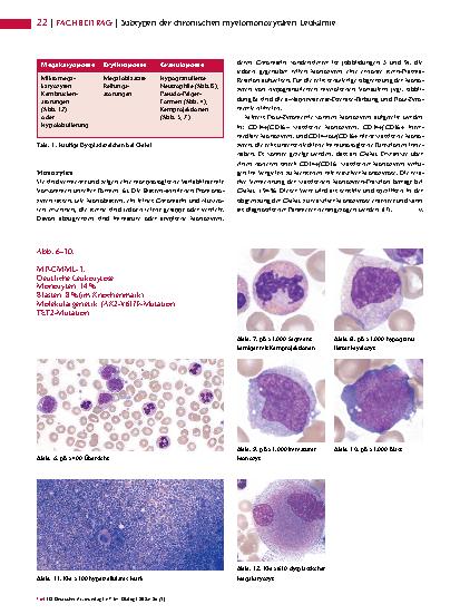 Vorschauseite 3: Dysplastisch oder proliferativ: Subtypen der chronischen myelomonozytären Leukämie