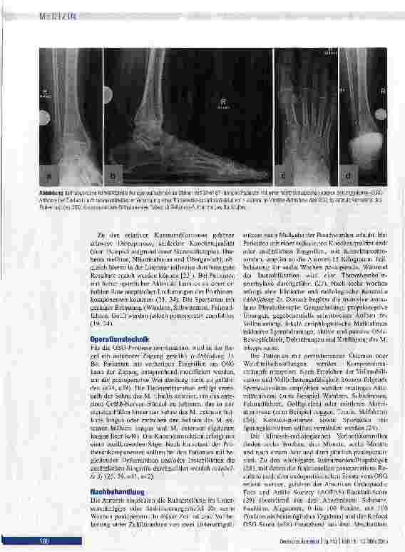Vorschauseite 4: Endoprothetischer Ersatz des oberen Sprunggelenks