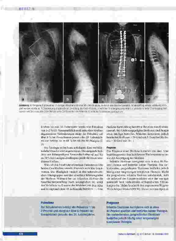 Vorschauseite 2: Die idiopathische Skoliose