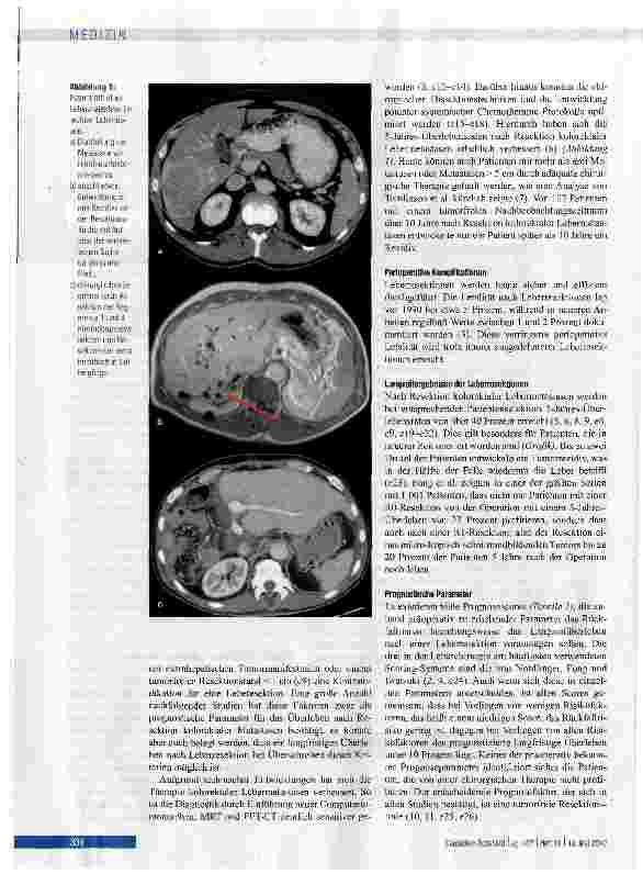 Vorschauseite 2: Chirurgische Therapie von Lebermetastasen beim kolorektalen Karzinom