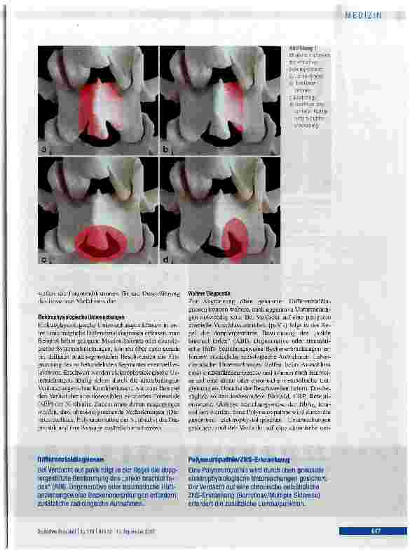 Vorschauseite 5: Degenerative lumbale Spinalkanalstenose im höheren Lebensalter