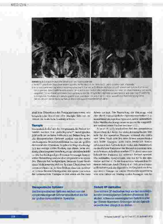 Vorschauseite 6: Degenerative lumbale Spinalkanalstenose im höheren Lebensalter