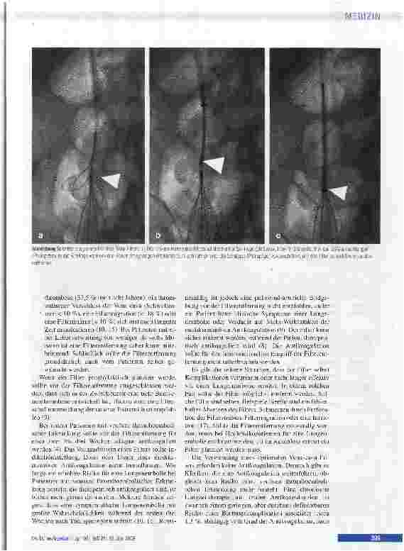 Vorschauseite 5: ÜBERSICHTSARBEITOptionale Vena-cava-FilterIndikationen, Management und Ergebnisse