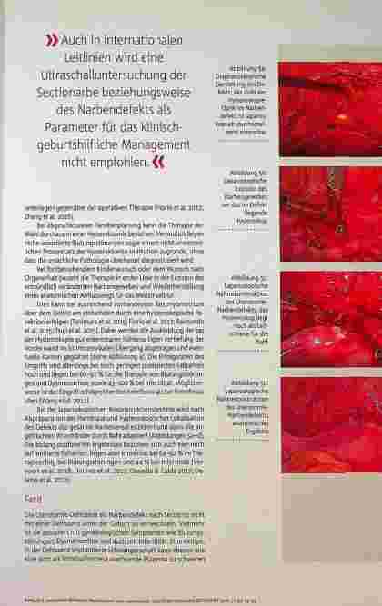 Vorschauseite 4: Narbendefekt nach Kaiserschnitt