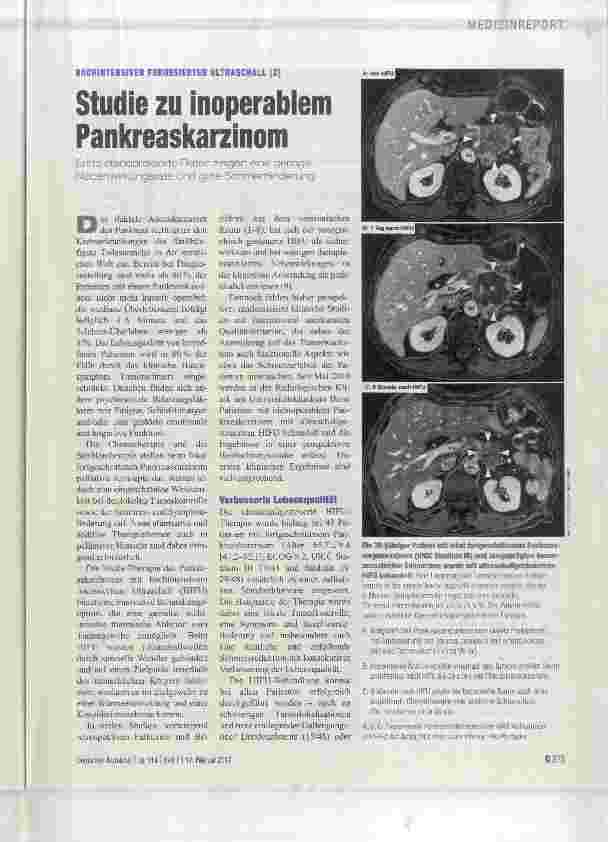Vorschauseite 1: HOCHINTENSIVER FOKUSSIERTER ULTRASCHALL (2) Studie zu inoperablem Pankreaskarzinom