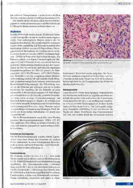 Vorschauseite 2: Retransplantation von kryokonserviertem ovariellen Gewebe