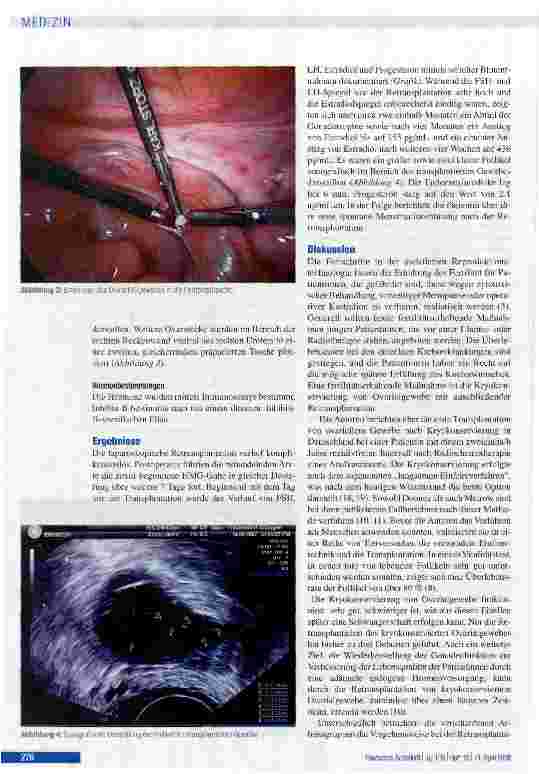 Vorschauseite 3: Retransplantation von kryokonserviertem ovariellen Gewebe