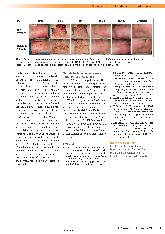 Vorschauseite 2: Ein Wundverband auf Basis von nanofibrillärer Cellulose zur Behandlung von Spenderarealen für die Hauttransplantation.