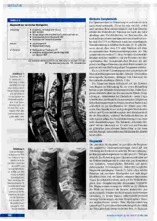 Vorschauseite 3: Die degenerative zervikale Spinalkanalstenose