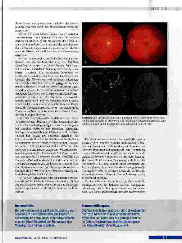 Vorschauseite 4: Diagnostik und Therapie der Optikusneuritis