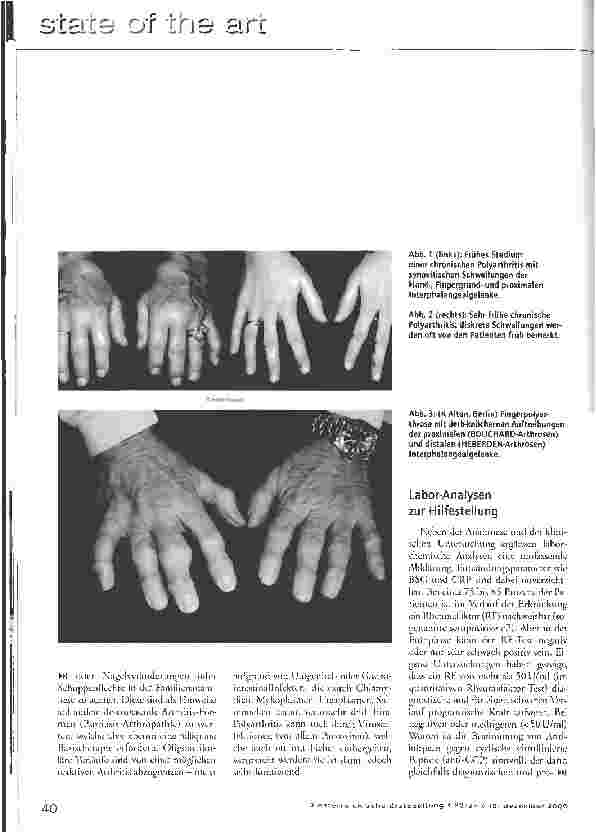 Vorschauseite 3: Chronische Polyarthritis