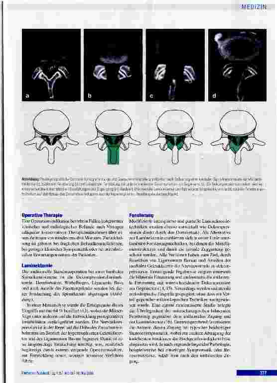 Vorschauseite 5: Die degenerative lumbale Spinalkanalstenose