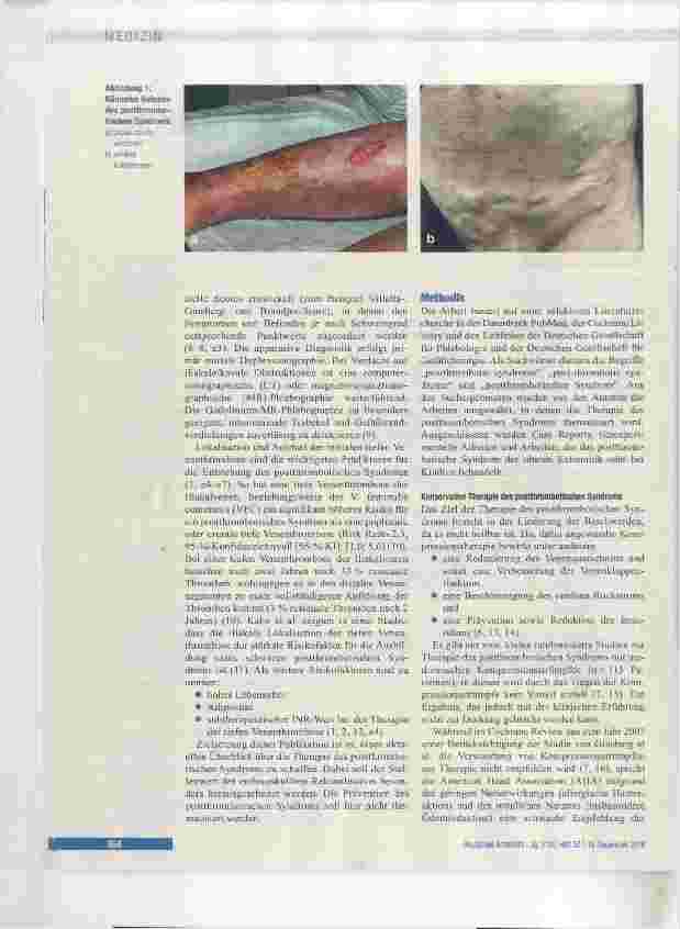 Vorschauseite 2: Therapie des postthrombotischen Syndroms