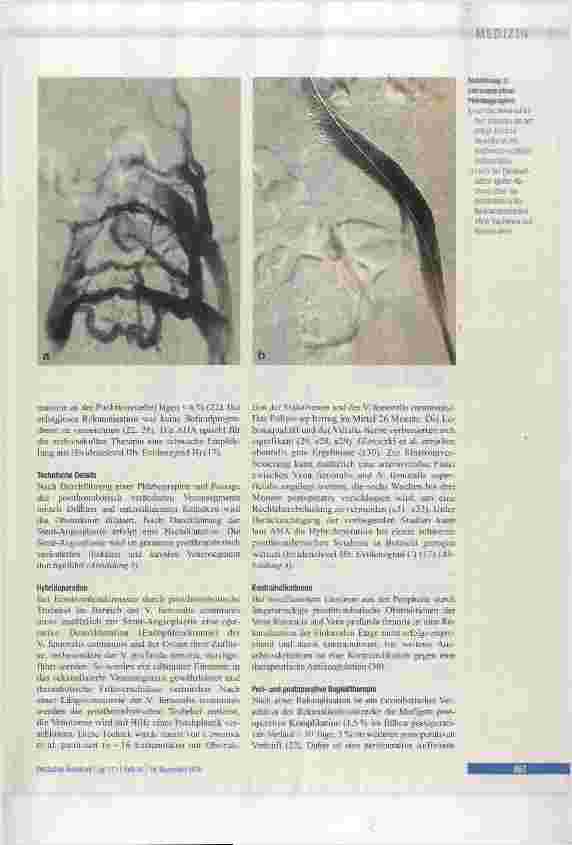 Vorschauseite 5: Therapie des postthrombotischen Syndroms