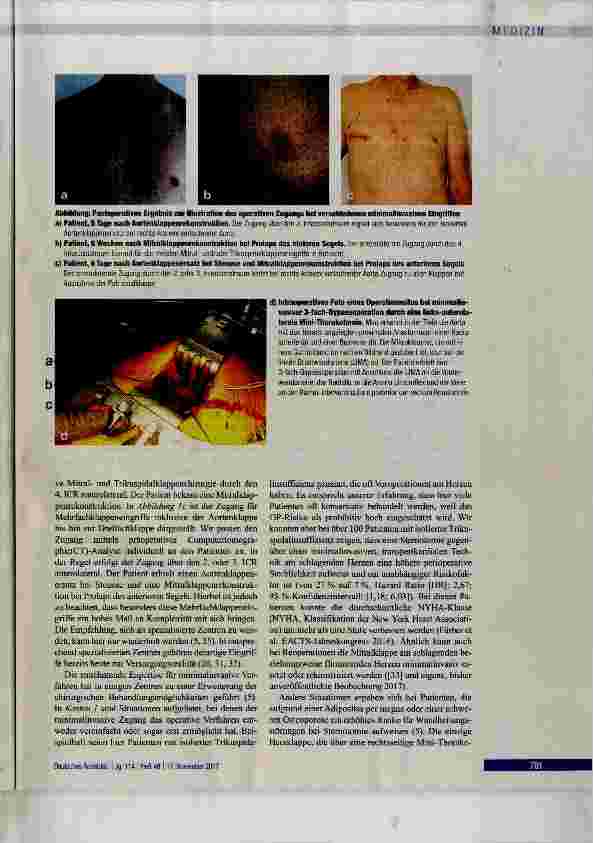 Vorschauseite 5: Möglichkeiten und Grenzen der minimalinvasiven Herzchirurgie