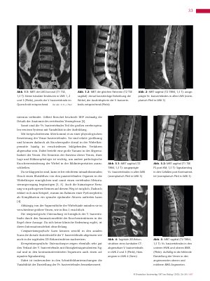 Vorschauseite 2: Anomalien und Normvarianten – Skelettale Veränderungen 3. 41: Venae basivertebrales