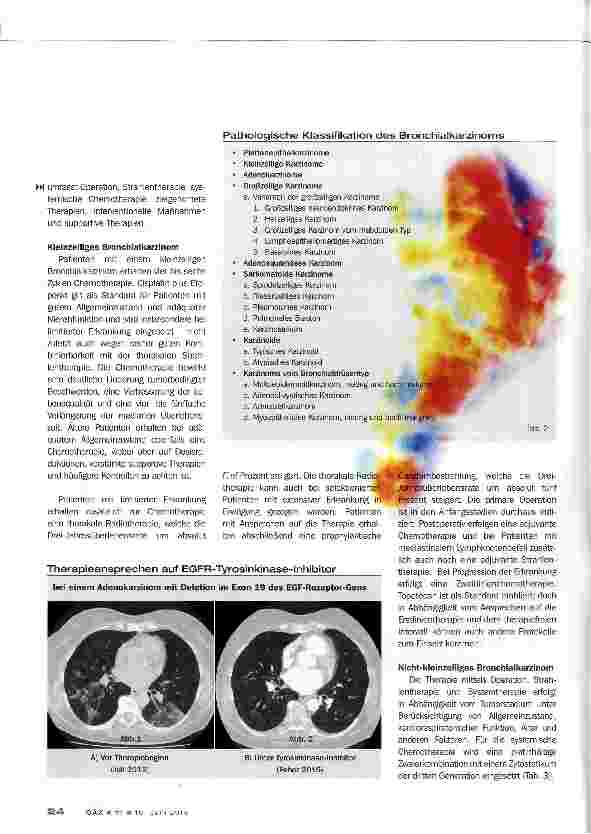 Vorschauseite 4: Bronchialkarzinom