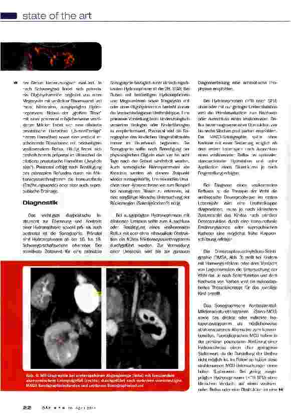 Vorschauseite 4: Kindliche Hydronephrose