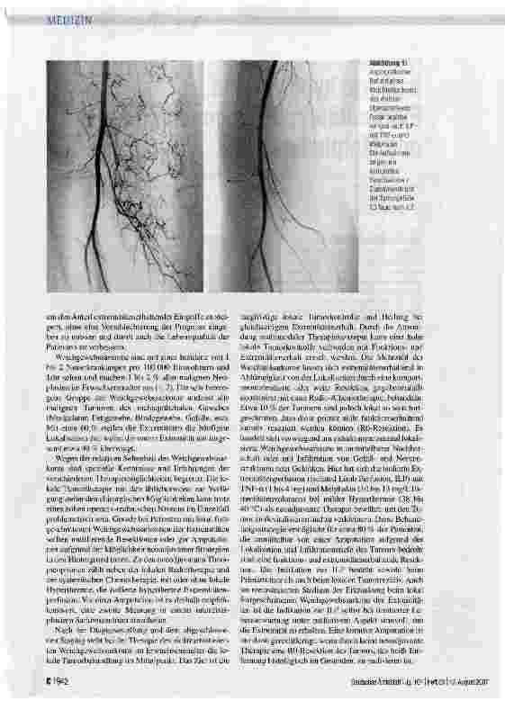 Vorschauseite 2: Isolierte hypertherme Extremitätenperfusion mit TNF-a und Melphalan