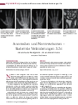 Vorschauseite 1: Anomalien und Normvarianten – Skelettale Veränderungen 3.26 Akzessoria des Handgelenks – Os vesalianum manus