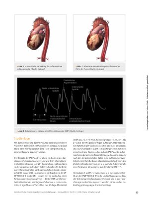 Vorschauseite 3: Intensivpflege bei intraaortaler Ballongegenpulsation – was muss beachtet werden?