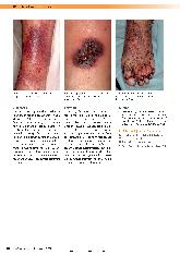 Vorschauseite 2: Kutane leukozytoklastische Angiitis