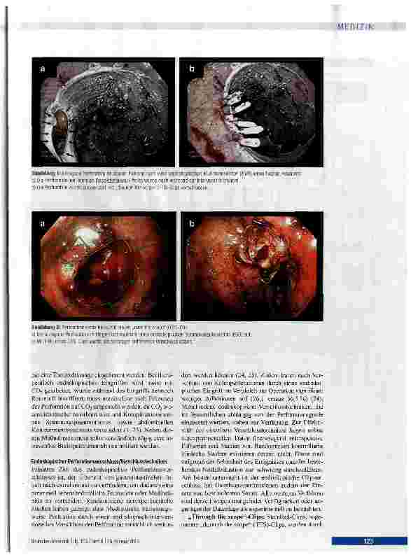 Vorschauseite 3: Endoskopische Behandlung iatrogener gastrointestinaler Perforationen