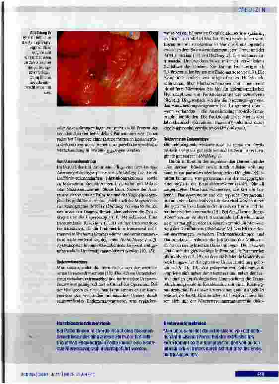 Vorschauseite 4: Diagnose und Therapie der tief-infiltrierenden Endometriose