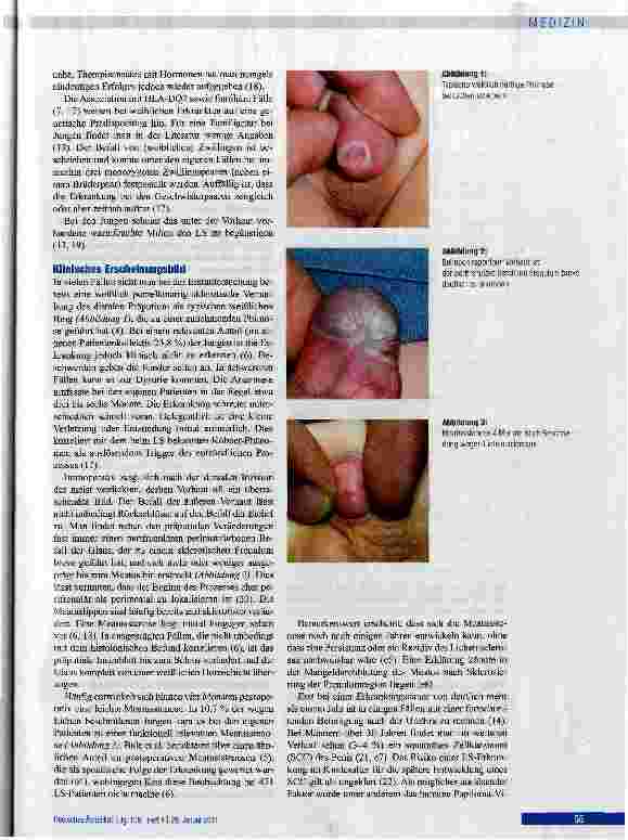 Vorschauseite 3: Liehen sclerosus bei Jungen