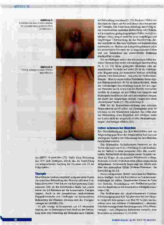Vorschauseite 4: Liehen sclerosus bei Jungen