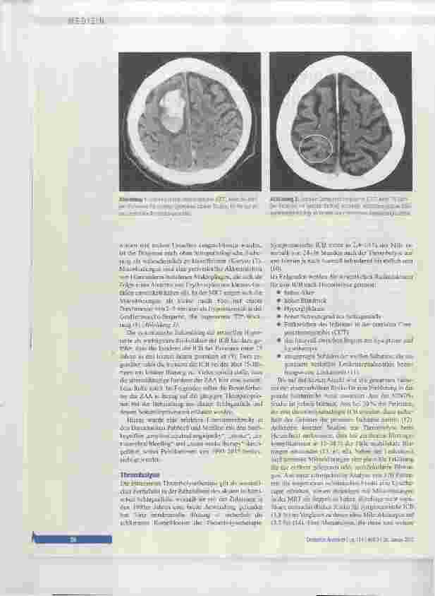 Vorschauseite 2: Zerebrale Amyloidangiopathie in der Schlaganfallmedizin