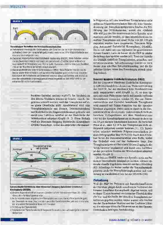 Vorschauseite 2: Hauchdünne Hornhauttransplantate -schnelle und gute Sehschärfenerholung