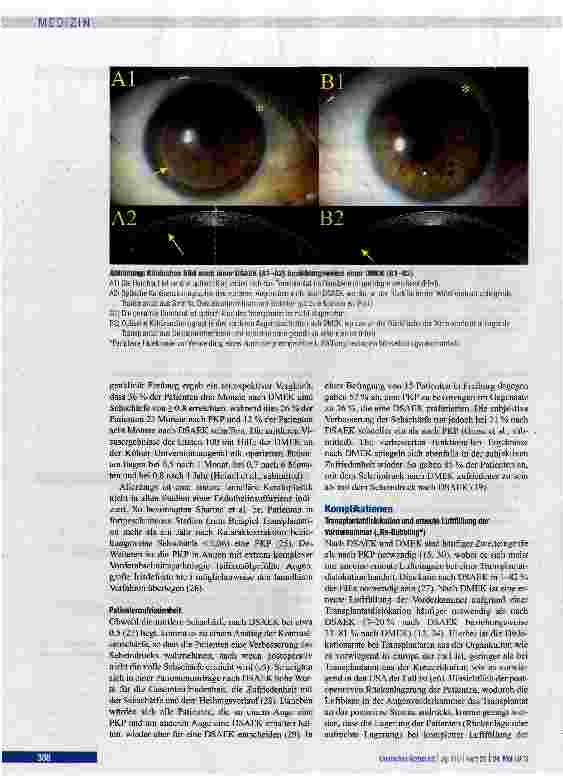 Vorschauseite 4: Hauchdünne Hornhauttransplantate -schnelle und gute Sehschärfenerholung