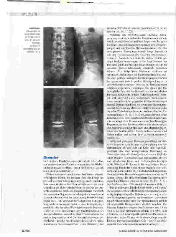 Vorschauseite 5: Die lumbale Bandscheibenprothese