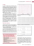 Vorschauseite 2: Das pathologische EKG: Ventrikuläre Herzrhythmusstörungen