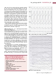Vorschauseite 4: Das pathologische EKG: Ventrikuläre Herzrhythmusstörungen