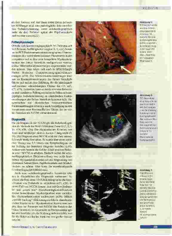 Vorschauseite 4: Isolierte Noncompaction-Kardiomyopathie