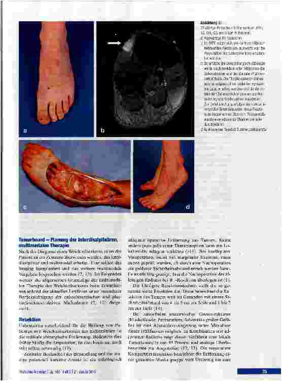 Vorschauseite 4: Diagnostik und Therapie von Weichteilsarkomen der Extremitäten