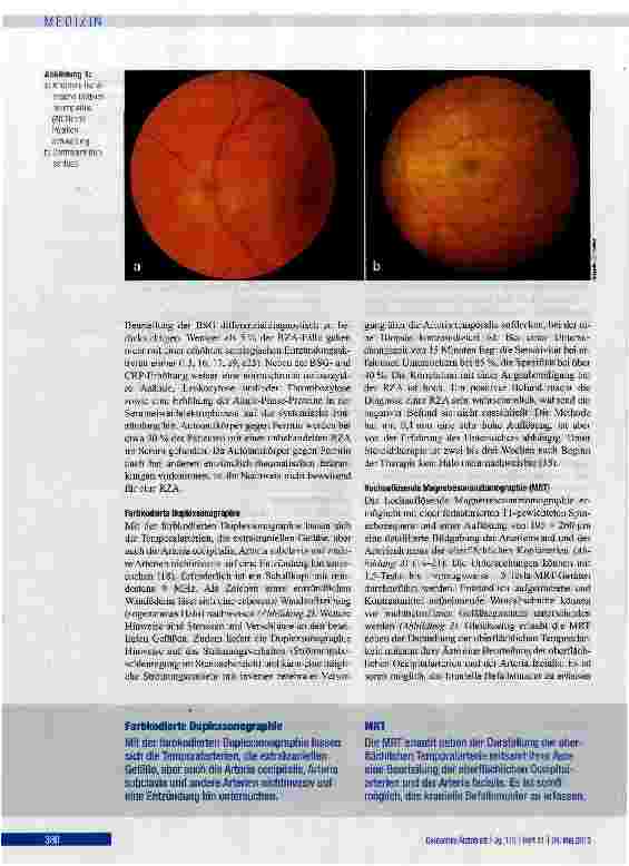 Vorschauseite 5: Diagnose und Therapie der Riesenzellarteriitis