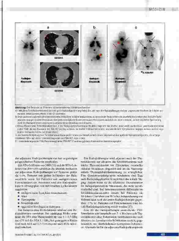 Vorschauseite 4: Therapie des differenzierten Schilddrüsenkarzinoms
